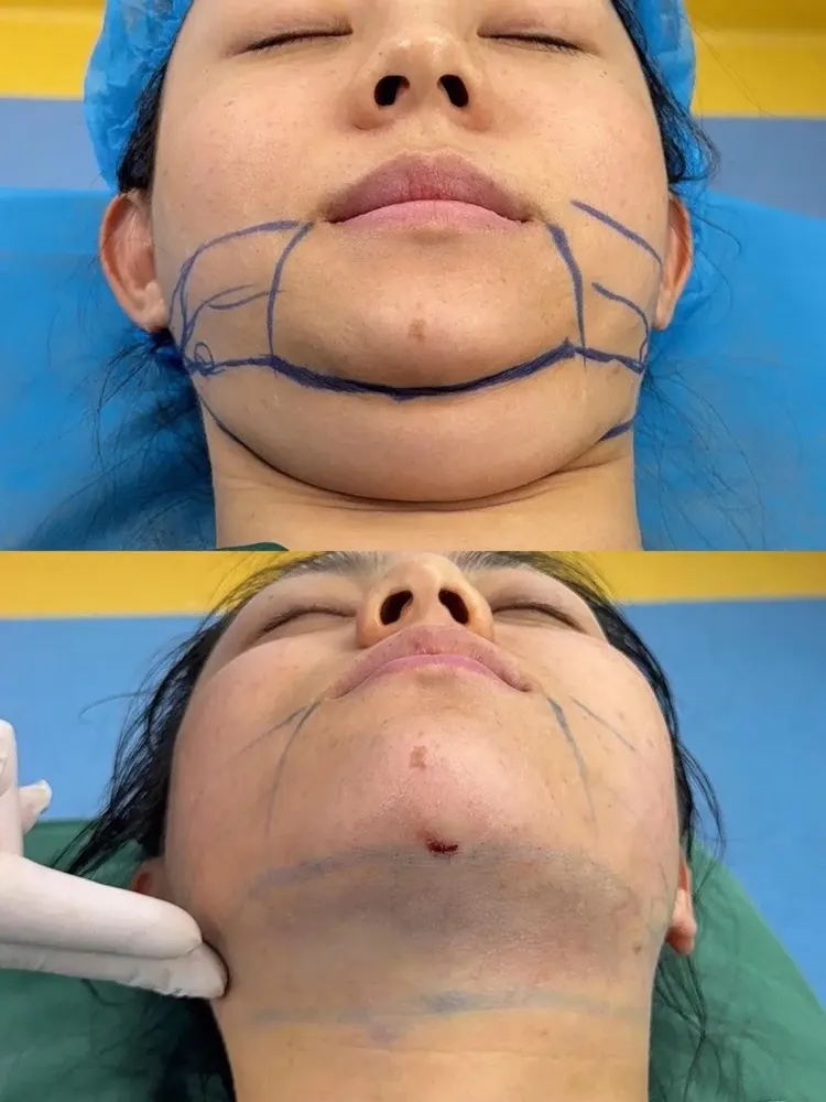 Liposuction of the chin area - before and after