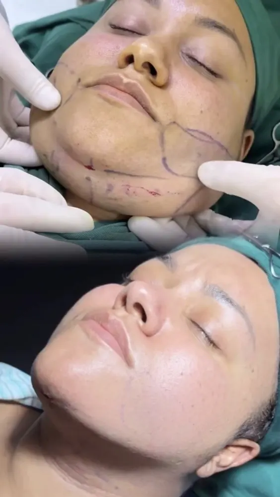 Liposuction of the chin area - before and after