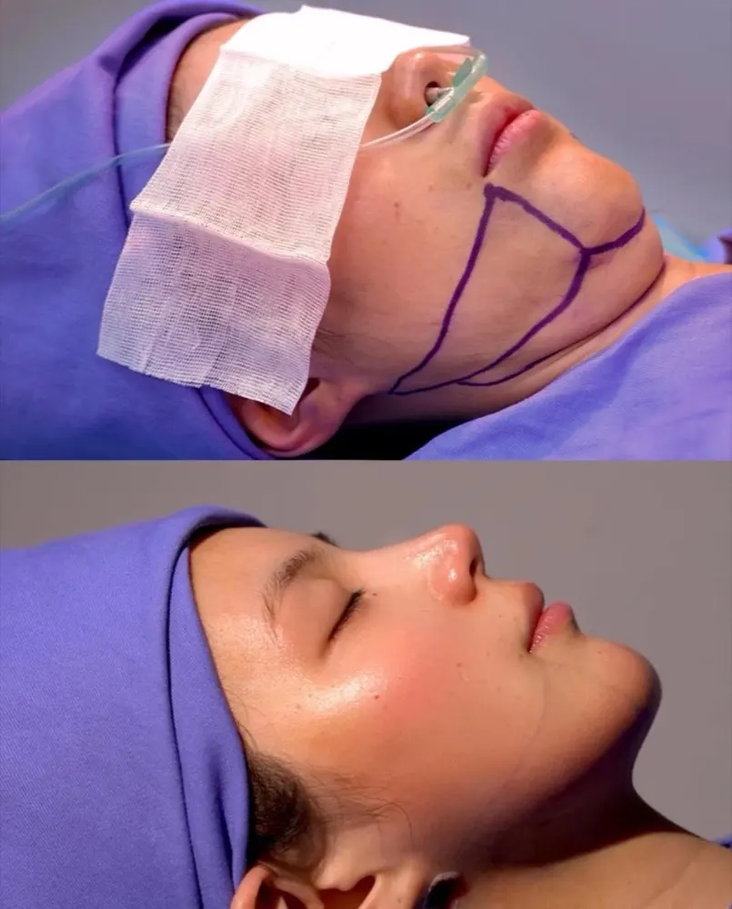 Liposuction of the chin area - before and after