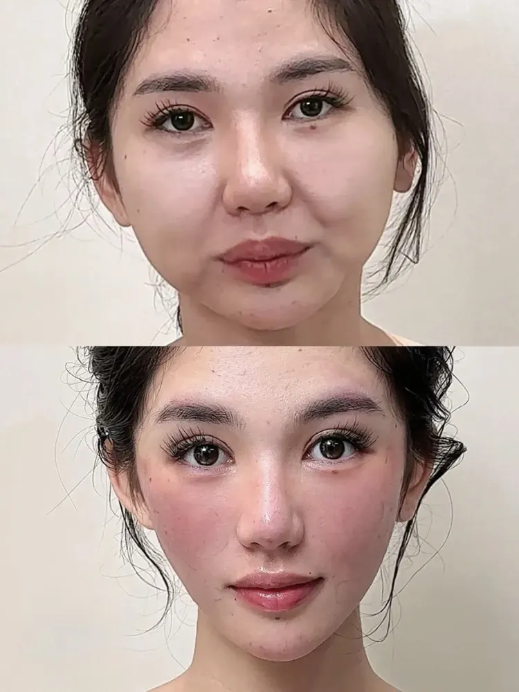 Facial liposuction - before and after