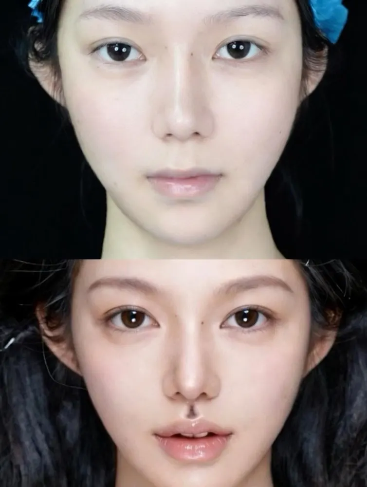Philtrumplasty - before and after