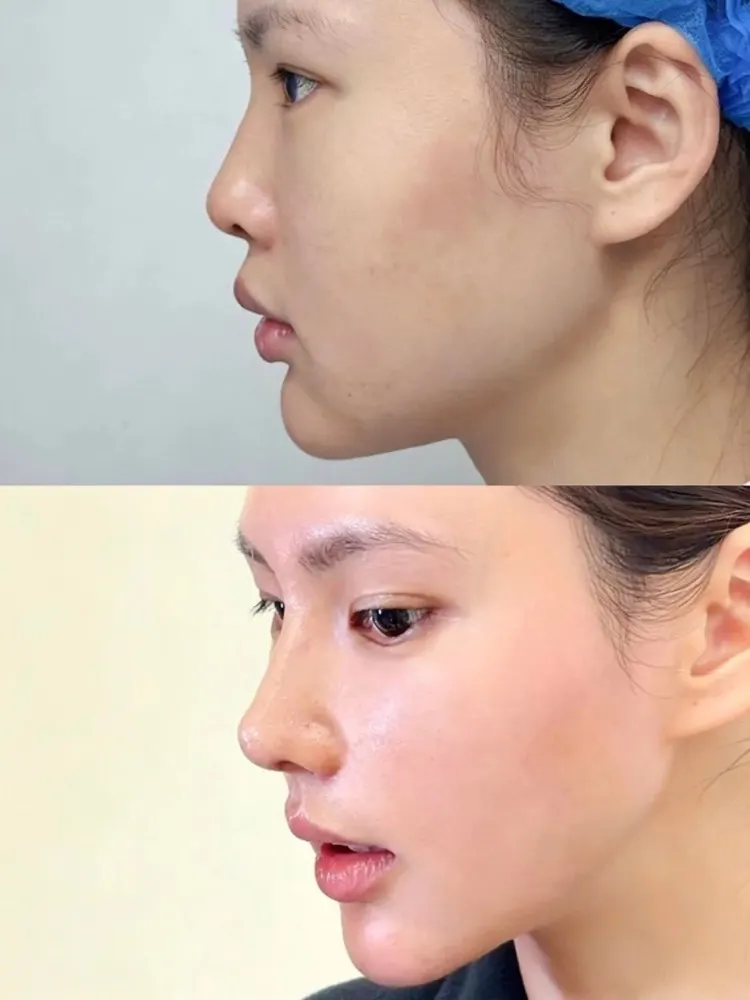 Rhinoplasty - before and after