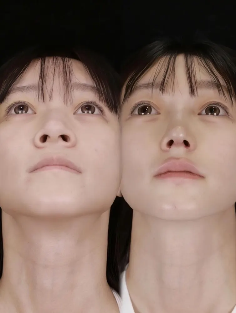 Rhinoplasty - before and after