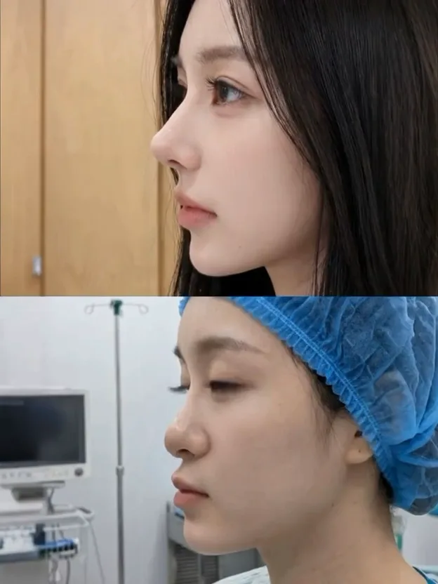 Rhinoplasty - before and after