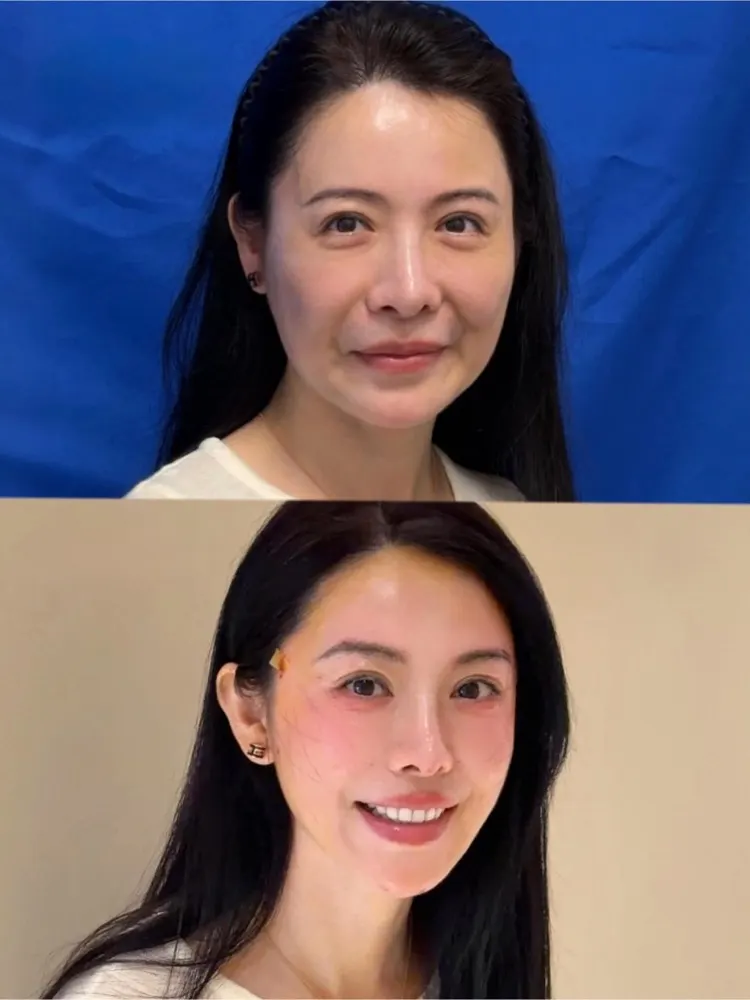 Smas lifting - before and after