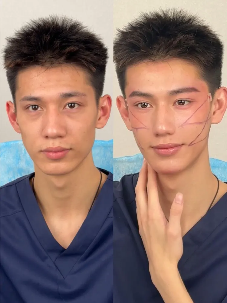 Smas lifting - before and after