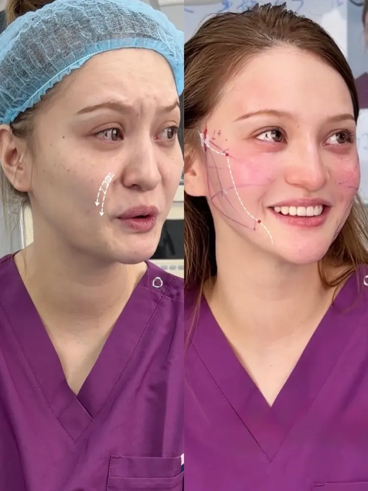 Smas lifting - before and after