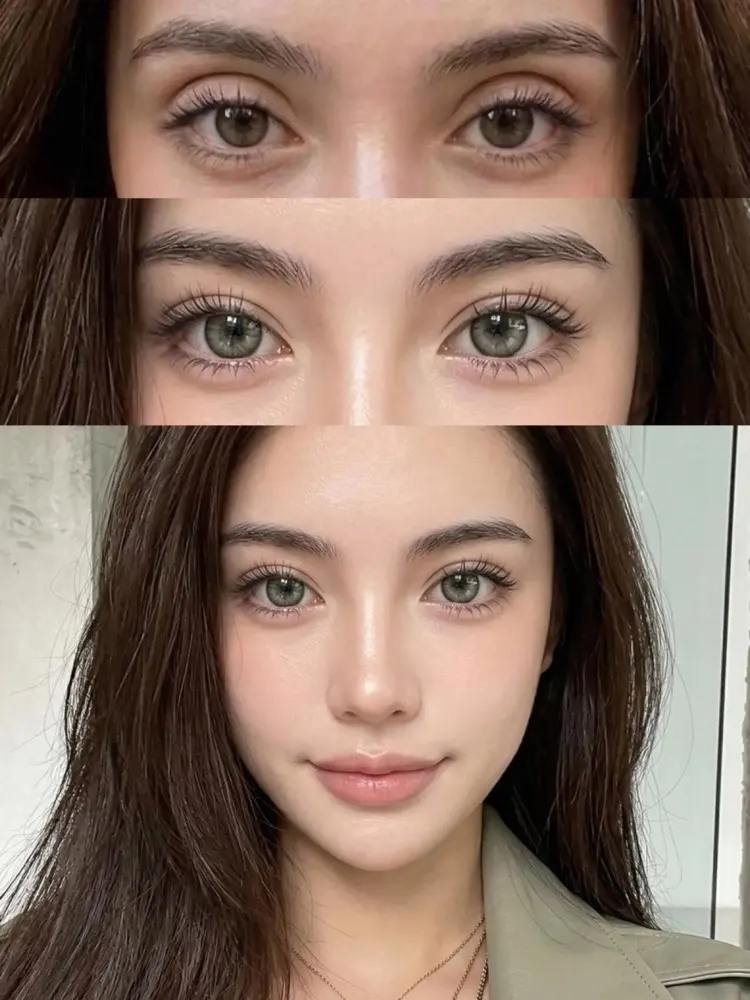 Lipofilling of the upper eyelid - before and after