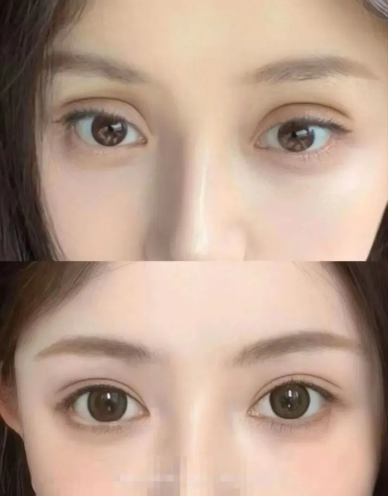 Lipofilling of the upper eyelid - before and after